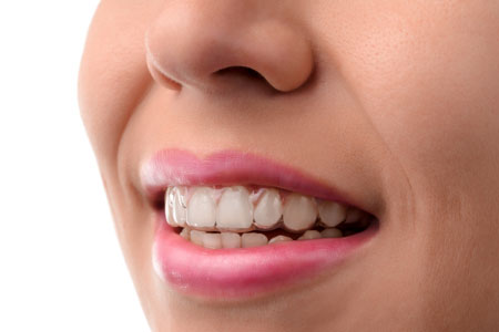 Clear Aligners