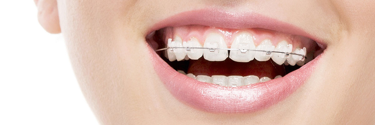 Englewood Invisible Orthodontics