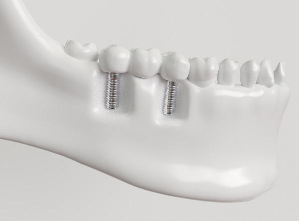 Understanding The Dental Bridge Procedure