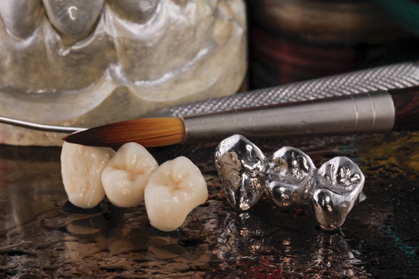 The Longevity Of Dental Bridges: What You Should Know