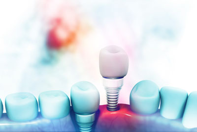 New Technology And Dental Implants In Englewood