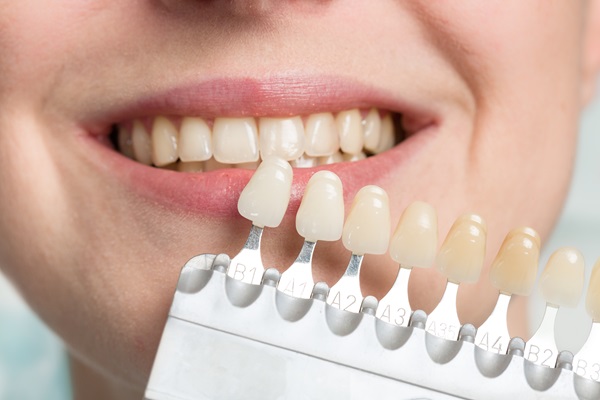 When Would A Dentist Recommend Dental Veneers?