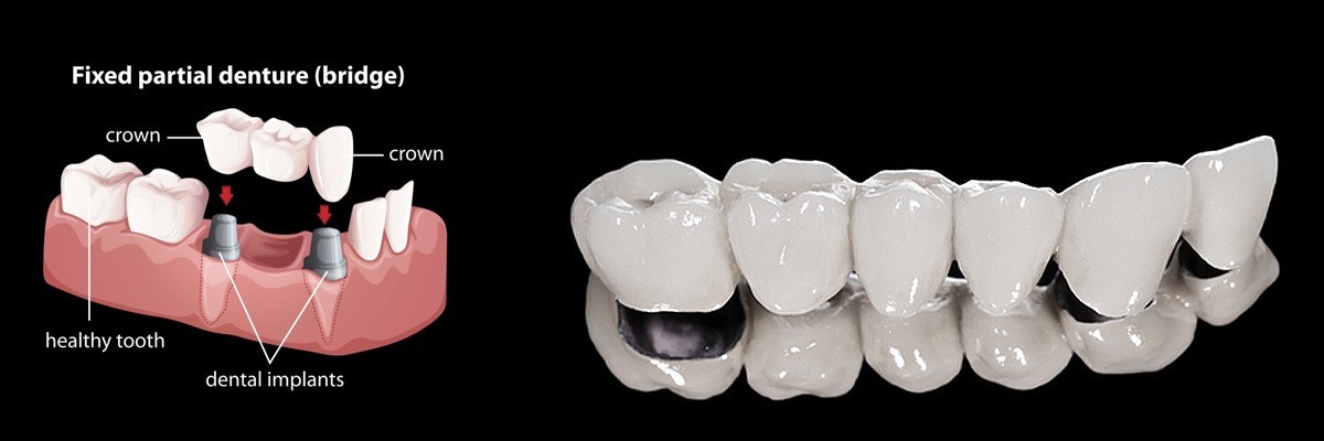 Englewood Dentures