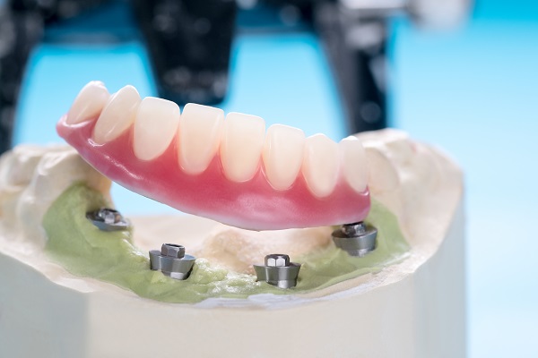 Can Implant Supported Dentures Improve Chewing Function?