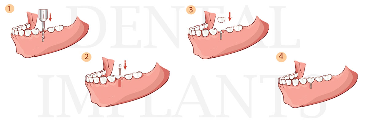 Englewood The Difference Between Dental Implants and Mini Dental Implants