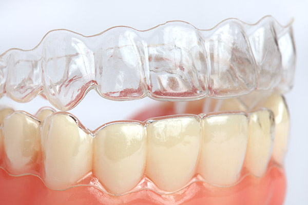 Complete Guide to Invisalign: How It Works