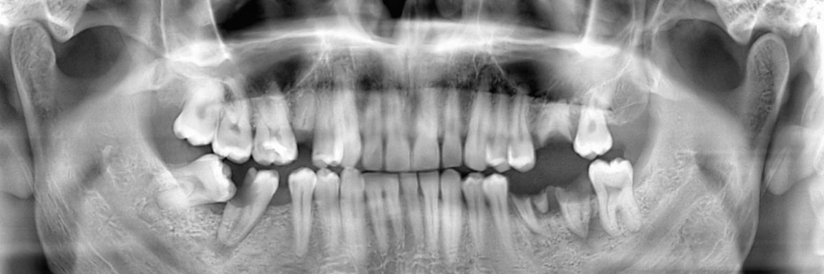 Englewood Options for Replacing Missing Teeth
