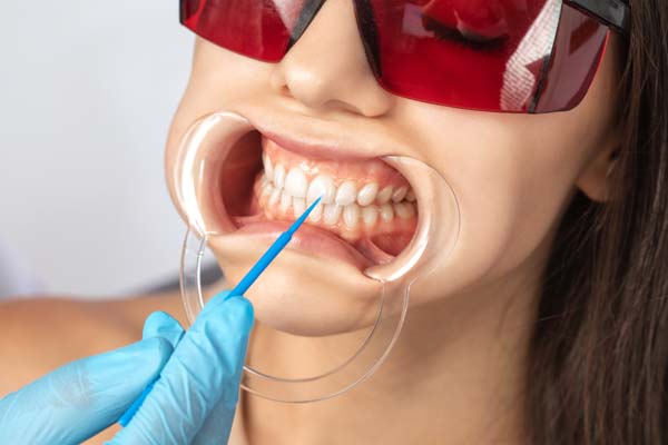 Teeth Whitening FAQs