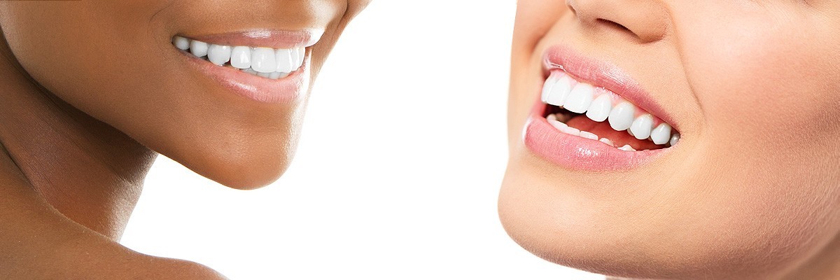 Englewood Teeth Whitening