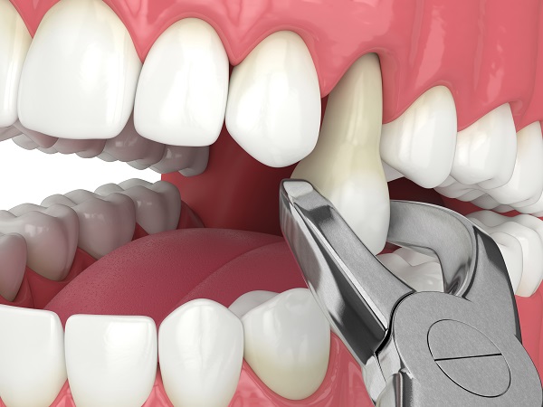 When Is Tooth Extraction Recommended By General Dentists?