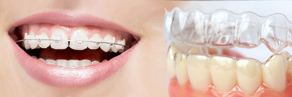 Englewood Which is Better Invisalign or Braces